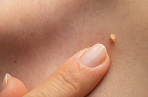 زگیل تناسلی(HPV)